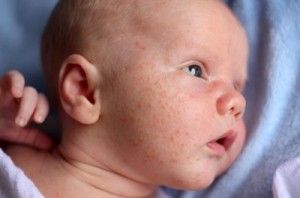 acne neonatal