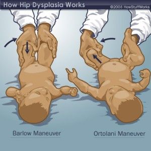 hip-dysplasia-screening