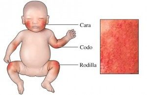 sintomas de la urticaria en bebés 